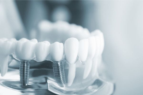 Cấy ghép implant là một trong những phương pháp phục hình nha khoa nổi tiếng